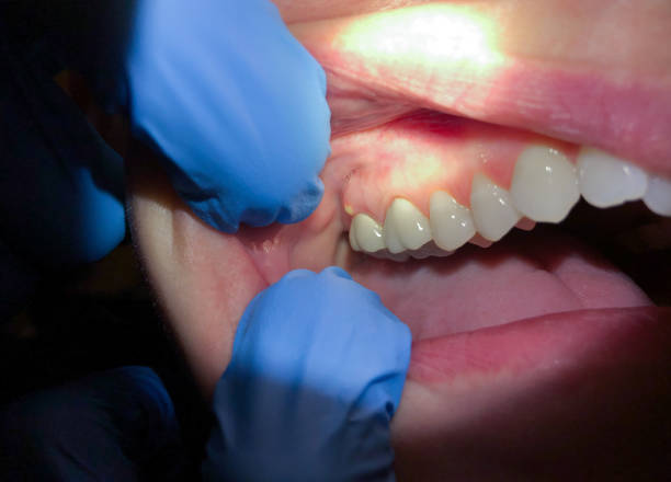 Best Emergency Wisdom Teeth Removal in Bar Nunn, WY